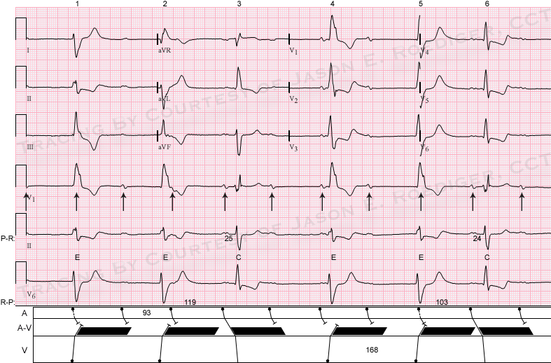 AV dissociation ECG Guru Instructor Resources